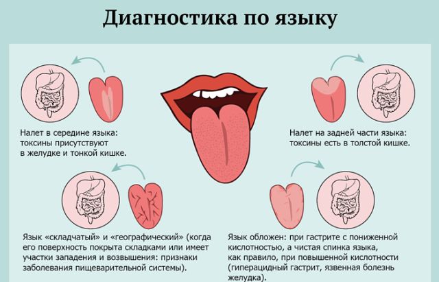 Жжение языка: причины, симптомы, лечение
